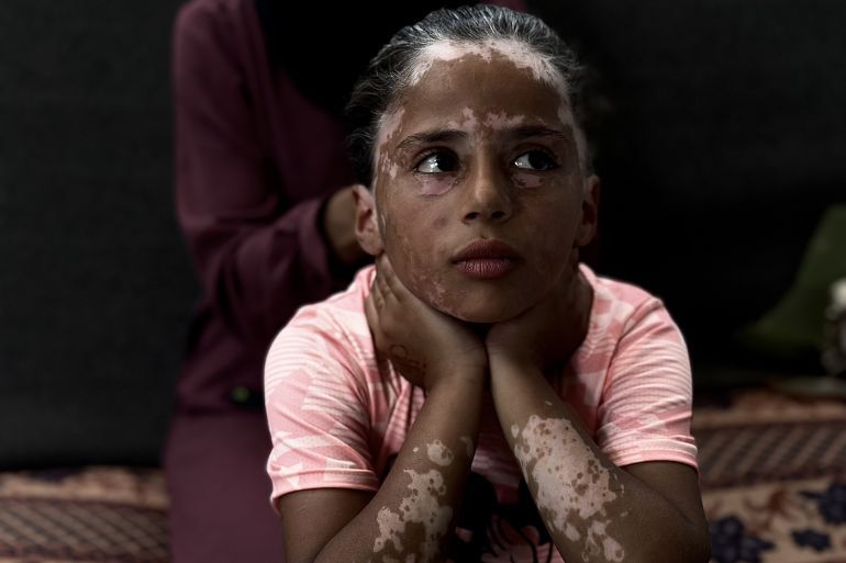 داخل خيمة مهترئة على أطراف أحد مخيمات النزوح بمدينة خان يونس جنوبي قطاع غزة، تجلس الطفلة الفلسطينية لانا الشريف متشبثة بما تبقى من طفولتها بعد 19 شهرا من حرب الإبادة الجماعية التي ترتكبها إسرائيل عاشت خلالها صدمات قاسية وأفقدتها معظم حقوقها. فلم ينجح القميص الوردي الذي ترتديه الشريف وطبع عليه شخصية