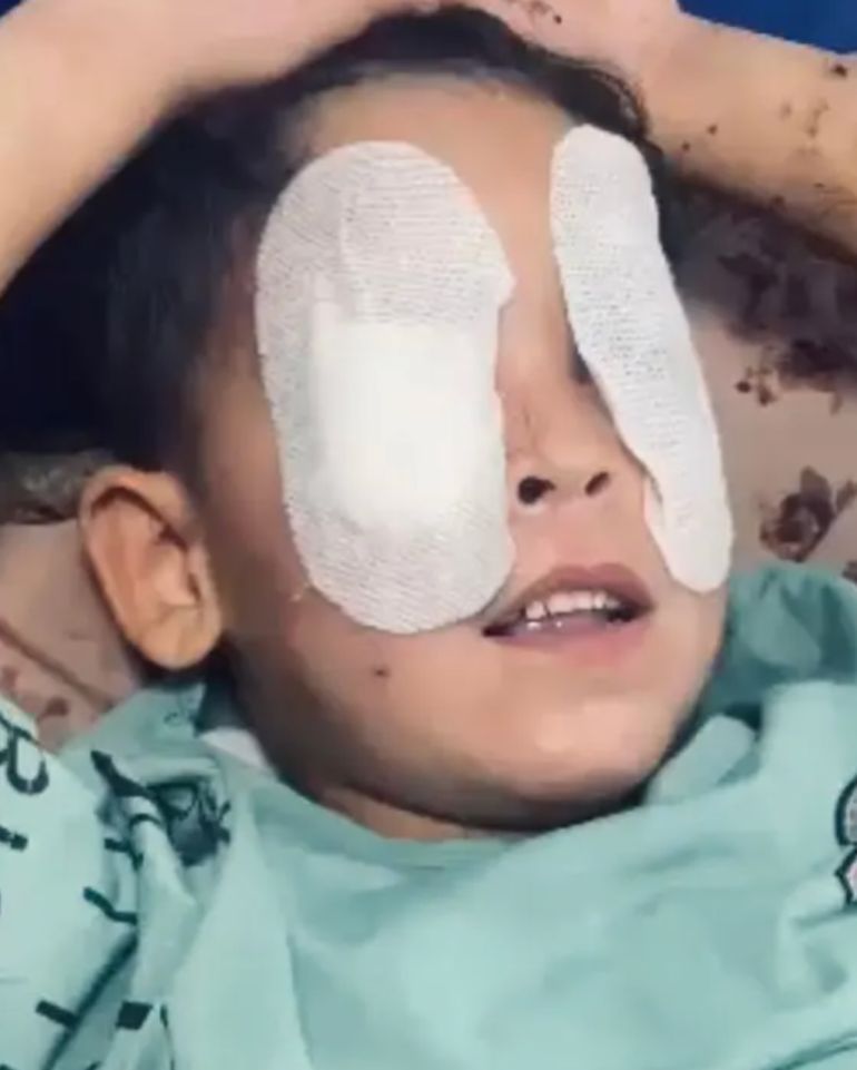 ***داخلية***** الطفل محمد حجازي (٧ أعوام) الذي فقد بصره نتيجة جسم مشبوه صادفه بين الركام أثناء لهوه أسفل منزله في جباليا (قبل وبعد الإصابة)