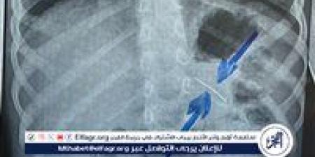 قسم الجراحة..ينجح فى استخراج دبوس من معدة صغير بسوهاج - الكويت الاخباري