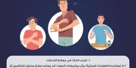 نصائج لعلاج  لدغات البعوض وتجنب آثارها .. تفاصيل - الكويت الاخباري