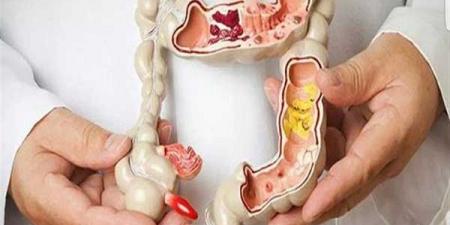 دراسة عقار يخفض خطر عودة سرطان القولون والوفاة بنسبة 50 #الصحة #منوعات #اخبار_الصحة #اخبار_منوعة #لايف_ستايل - الكويت الاخباري