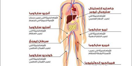 الساركوما سرطان عدواني لم تسمع به من قبل - الكويت الاخباري