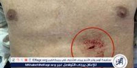 فريق طبي بمستشفى المنصورة الدولي ينقذ شابًا من موت محقق بعد طعنة مباشرة في القلب - الكويت الاخباري