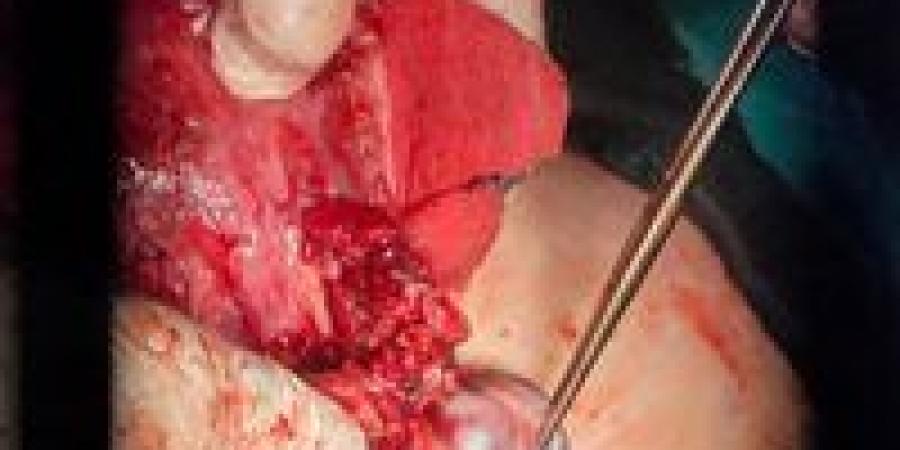 لديها تاريخ مرضي..إنقاذ لحالة ولادة حرجة بمستشفى أشمون العام بالمنوفية - الكويت الاخباري