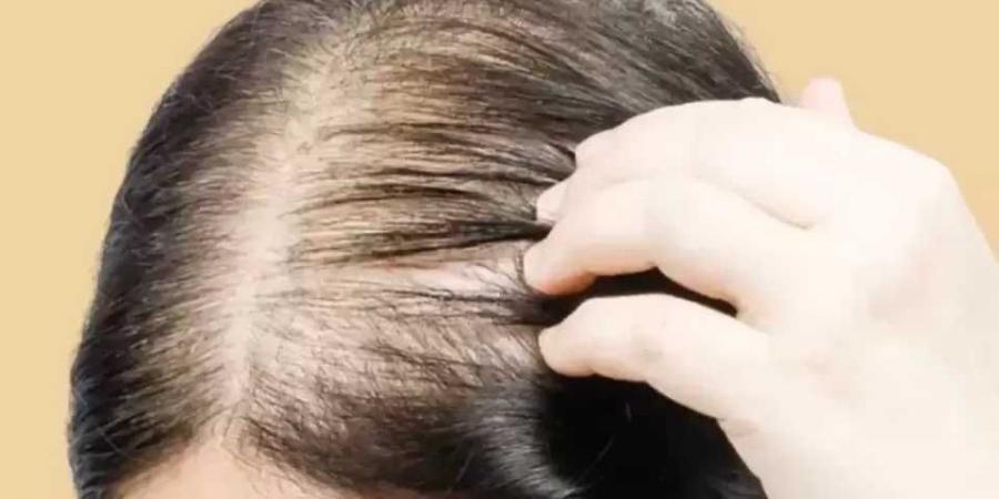 حلول حديثة لمعالجة الصلع الوراثي.. ما هي - الكويت الاخباري