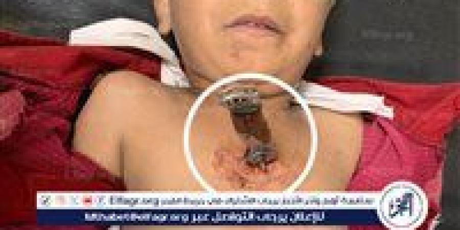 فريق طبي ينجح في إنقاذ طفل بمعجزة لتعرضه لضربة بآلة حادة بالصدر - الكويت الاخباري