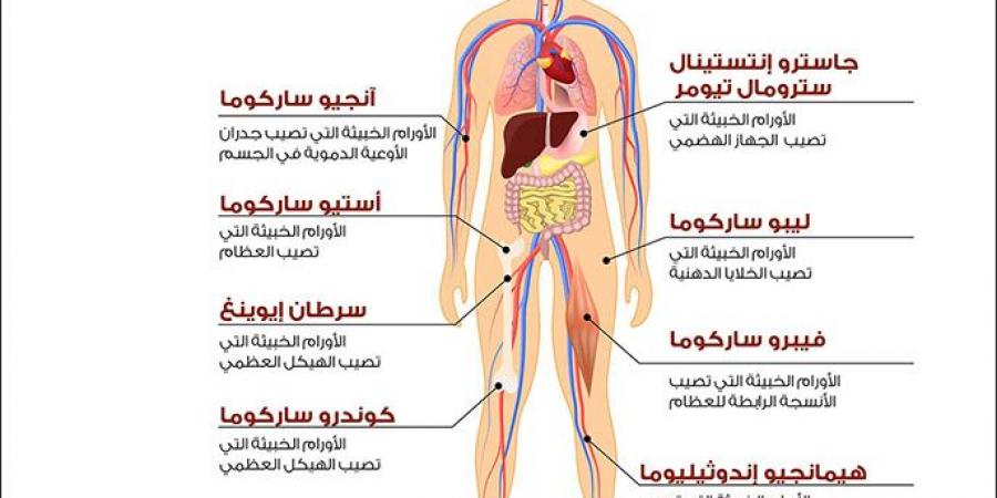 الساركوما سرطان عدواني لم تسمع به من قبل - الكويت الاخباري