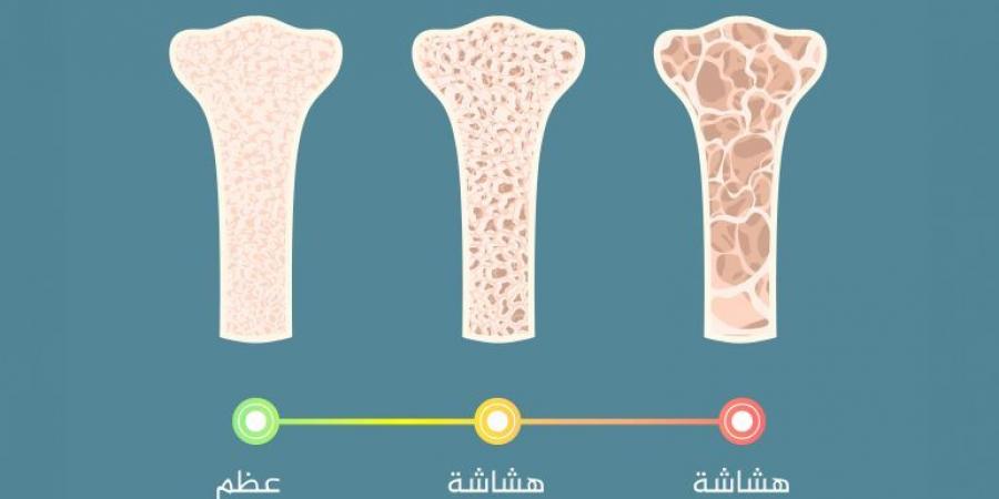 هل تشكل صحة العظام قلقا للرجال؟ - الكويت الاخباري