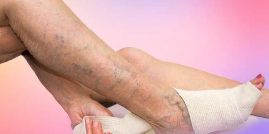 وداعًا للدوالي دون عمليات.. طرق فعالة لعلاج دوالي الساق في المنزل - الكويت الاخباري