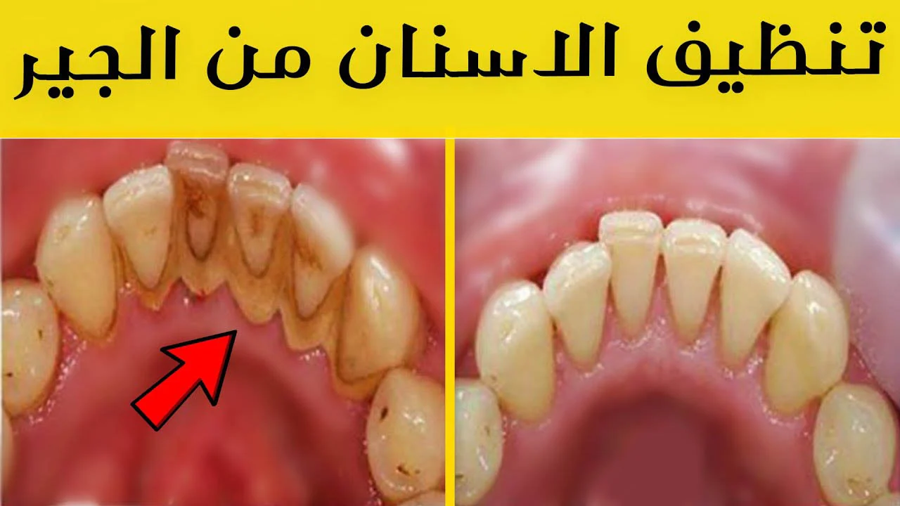 أسهل وصفة لتبييض الأسنان وإزالة الجير والتصبغات بدون طبيب في المنزل