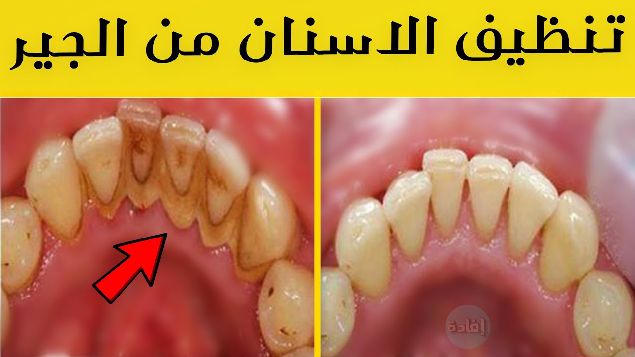 وداعاً لطبيب الأسنان وعمليات الليزر طريقة سحرية لتبييض الأسنان وإزالة الجير خلال دقيقتين فقط تعرف عليها وجربها فورا