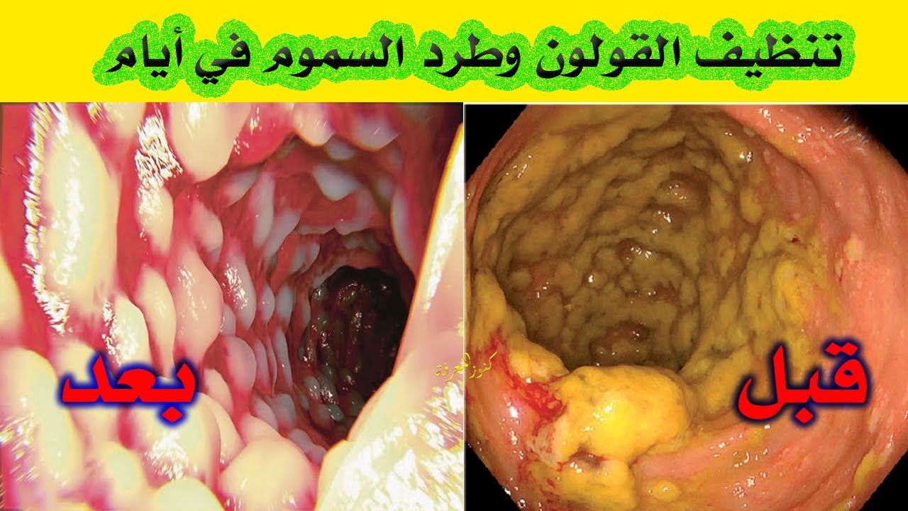 تنظيف القولون والتخلص من الفضلات الكريهة والبراز المتحجر سيختفي الإمساك تماما