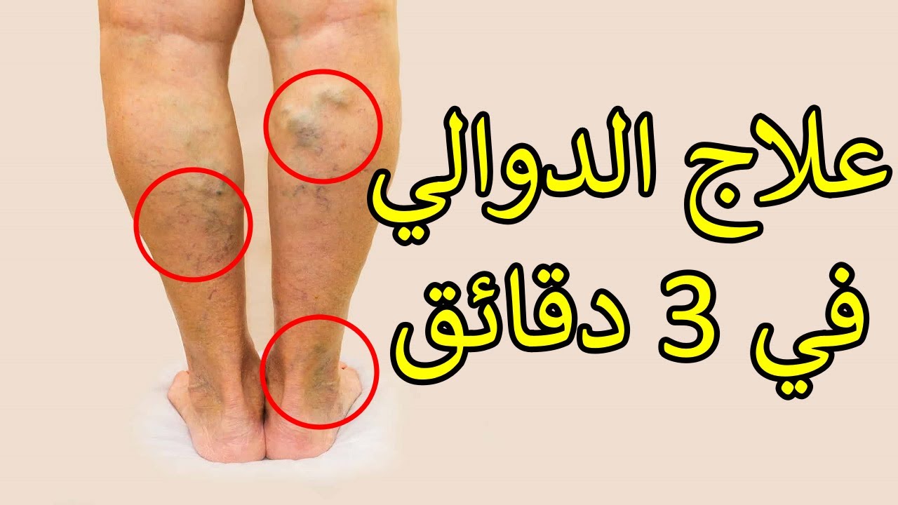 أفضل وصفة لازالة الدوالي نهائيا بمكونات طبيعية من المنزل