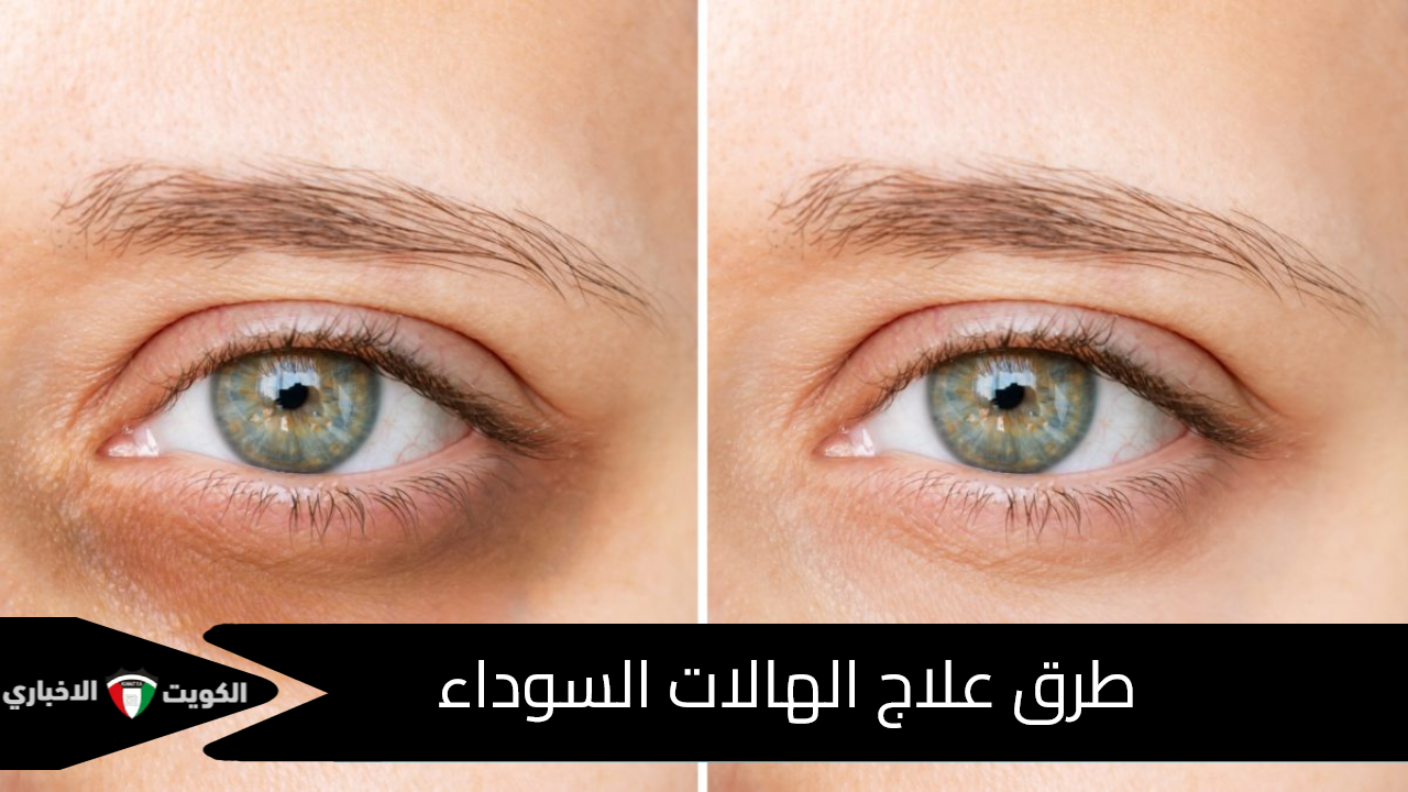 طرق علاج الهالات السوداء